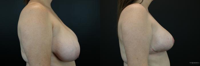 Before & After Breast Reduction Case 216 Right Side View in St. Louis, MO
