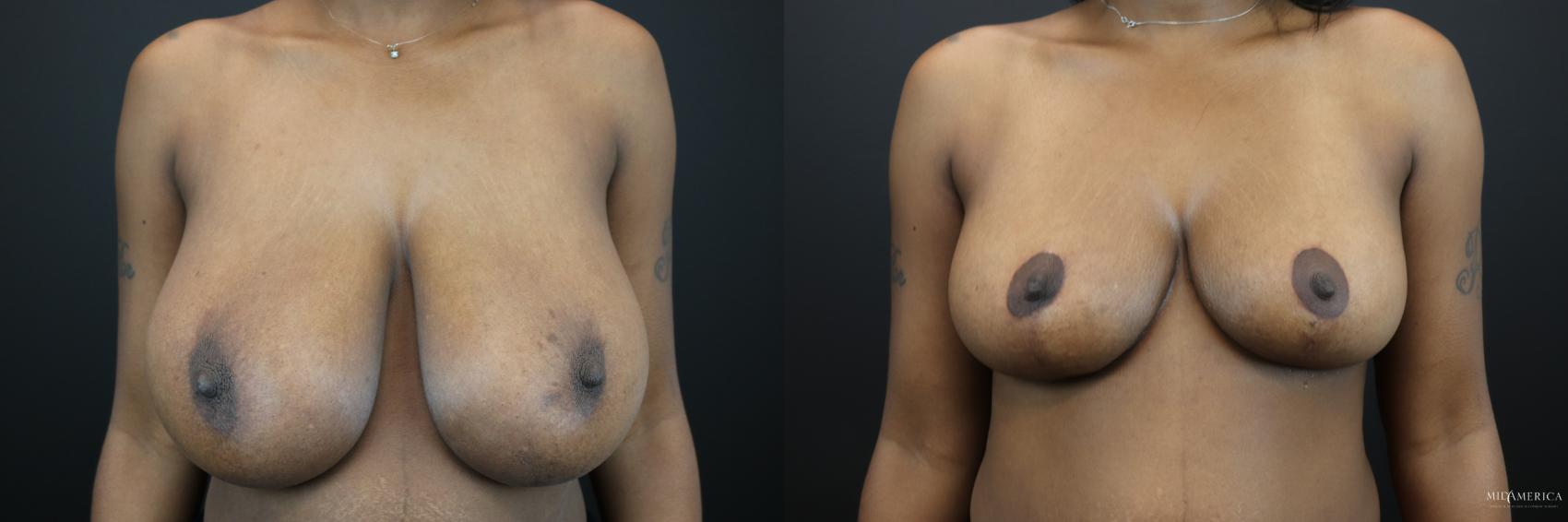 Before & After Breast Reduction Case 229 Front View in Glen Carbon, IL