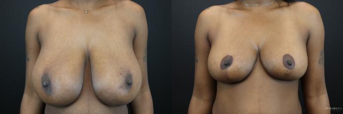 Before & After Breast Reduction Case 229 Front View in St. Louis, MO