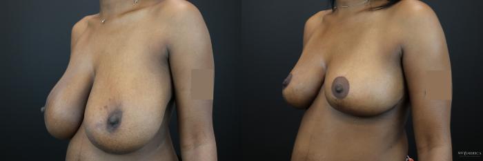Before & After Breast Reduction Case 229 Left Oblique View in St. Louis, MO