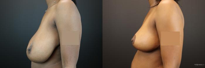 Before & After Breast Reduction Case 229 Left Side View in St. Louis, MO