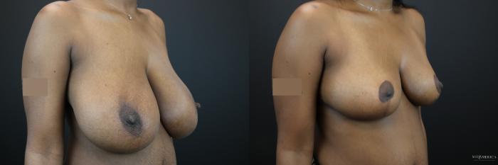Before & After Breast Reduction Case 229 Right Oblique View in St. Louis, MO