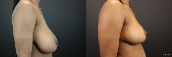 Before & After Breast Reduction Case 229 Right Side View in St. Louis, MO