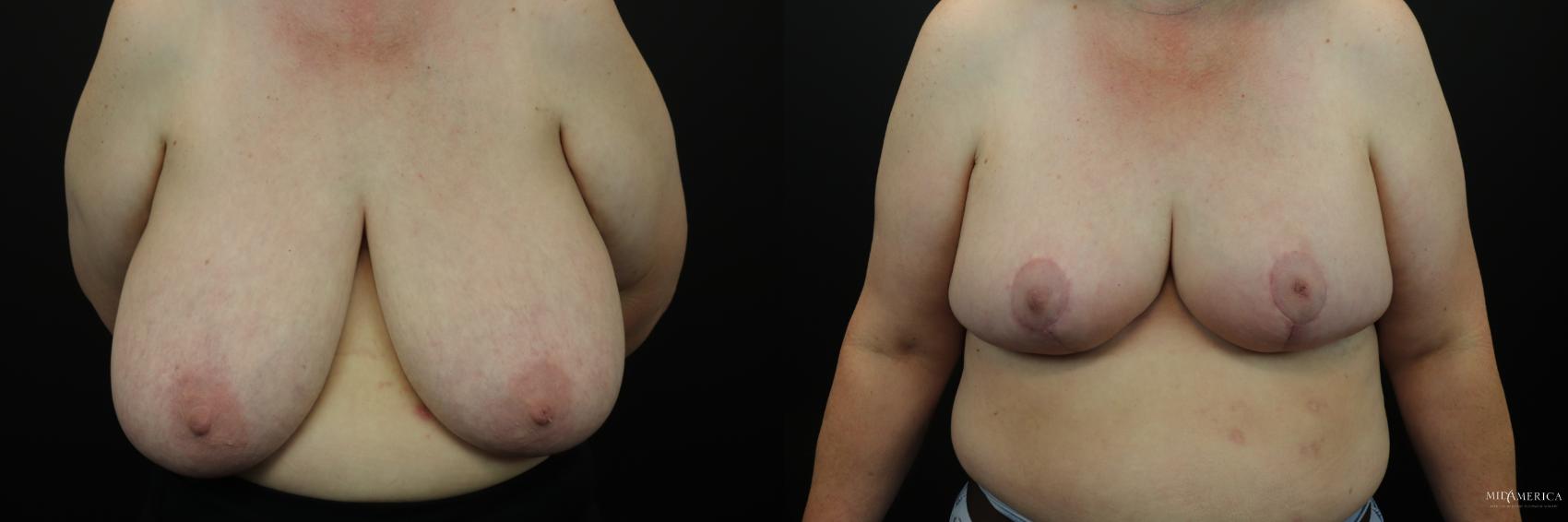 Before & After Breast Reduction Case 232 Front View in Glen Carbon, IL