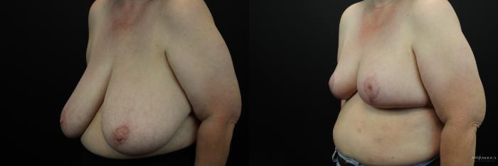Before & After Breast Reduction Case 232 Left Oblique View in Glen Carbon, IL