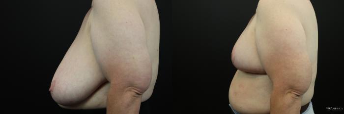 Before & After Breast Reduction Case 232 Left Side View in Glen Carbon, IL