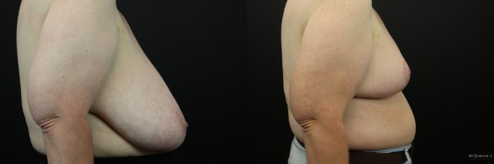 Before & After Breast Reduction Case 232 Right Side View in Glen Carbon, IL