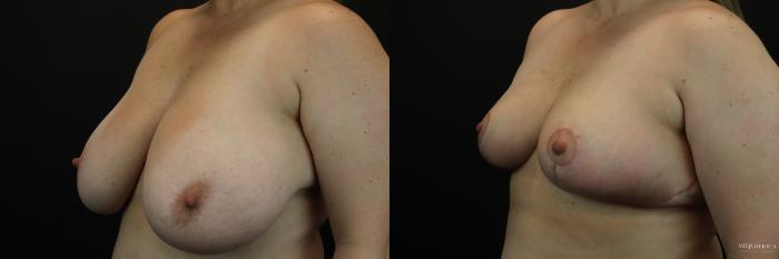 Before & After Breast Reduction Case 234 Left Oblique View in Glen Carbon, IL