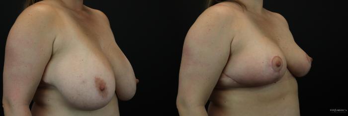 Before & After Breast Reduction Case 234 Right Oblique View in Glen Carbon, IL