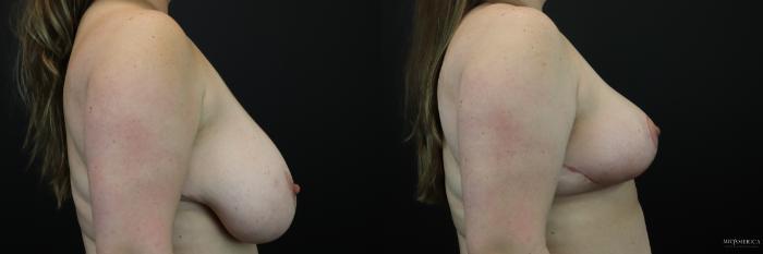 Before & After Breast Reduction Case 234 Right Side View in Glen Carbon, IL