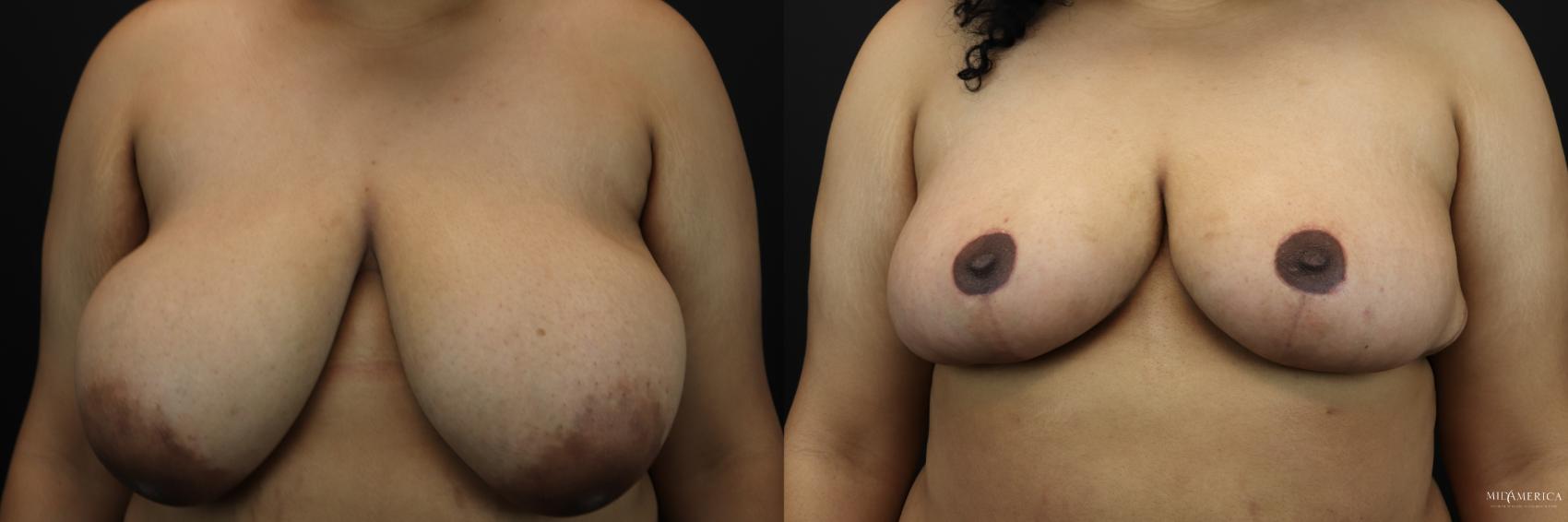 Before & After Breast Reduction Case 243 Front View in Glen Carbon, IL