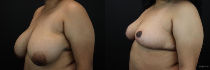 Before & After Breast Reduction Case 243 Left Oblique View in St. Louis, MO