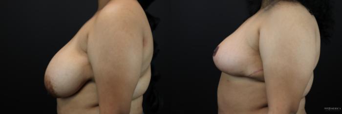 Before & After Breast Reduction Case 243 Left Side View in St. Louis, MO
