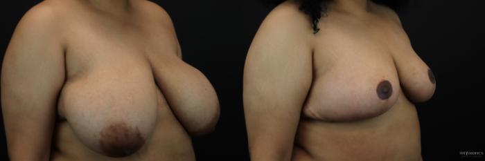 Before & After Breast Reduction Case 243 Right Oblique View in St. Louis, MO