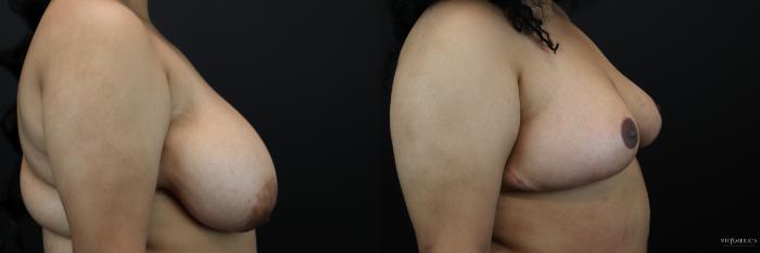 Before & After Breast Reduction Case 243 Right Side View in St. Louis, MO