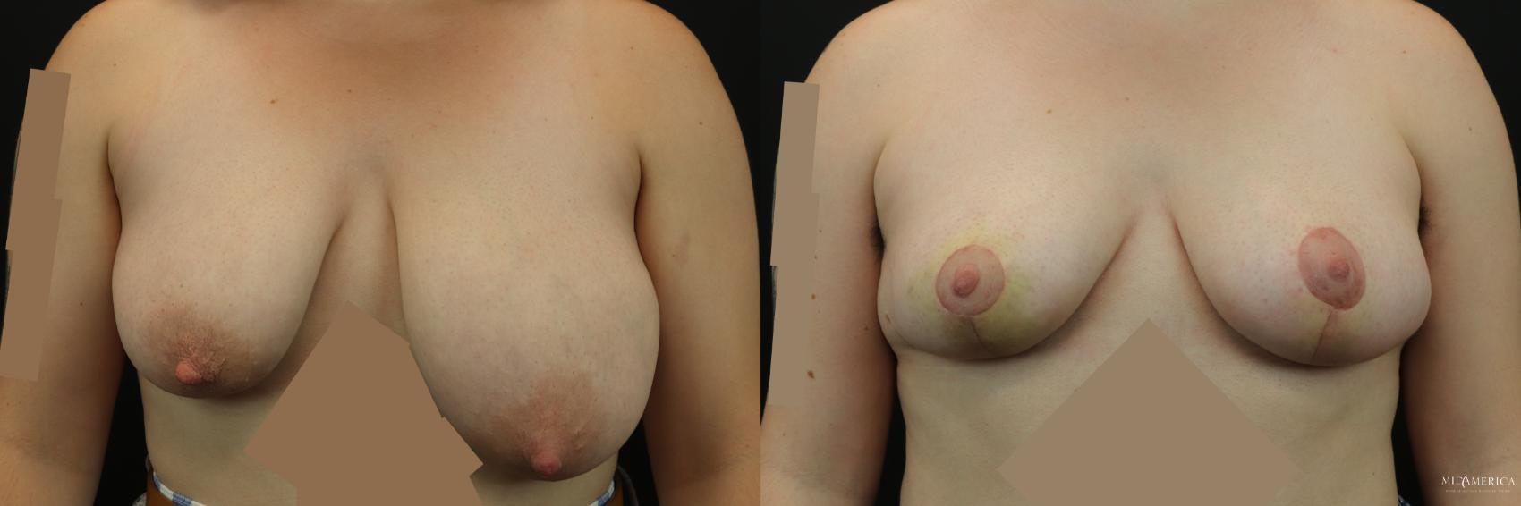 Before & After Breast Reduction Case 244 Front View in St. Louis, MO