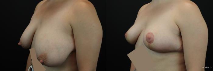 Before & After Breast Reduction Case 244 Left Oblique View in St. Louis, MO
