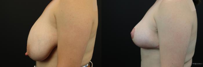 Before & After Breast Reduction Case 244 Left Side View in St. Louis, MO