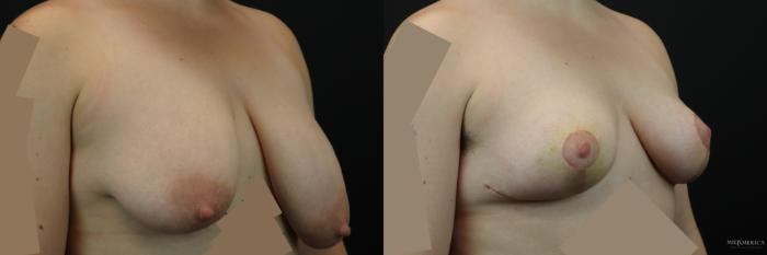 Before & After Breast Reduction Case 244 Right Oblique View in St. Louis, MO