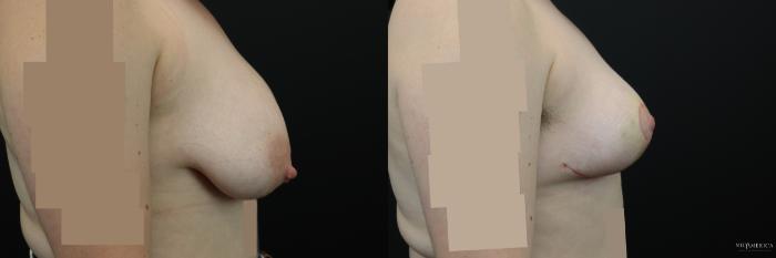 Before & After Breast Reduction Case 244 Right Side View in St. Louis, MO