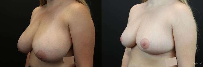 Before & After Breast Reduction Case 245 Left Oblique View in Glen Carbon, IL