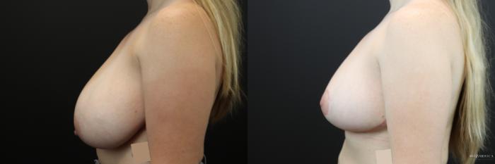 Before & After Breast Reduction Case 245 Left Side View in Glen Carbon, IL