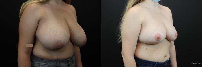 Before & After Breast Reduction Case 245 Right Oblique View in Glen Carbon, IL