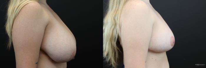 Before & After Breast Reduction Case 245 Right Side View in Glen Carbon, IL
