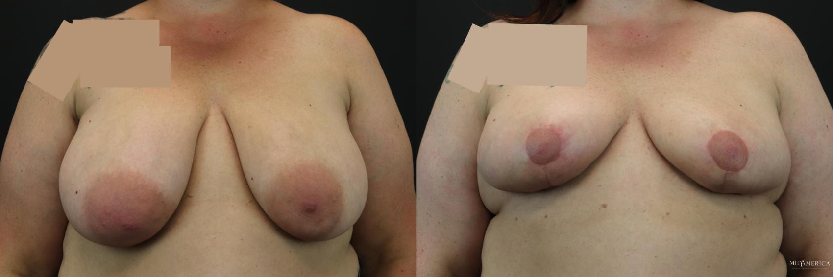 Before & After Breast Reduction Case 246 Front View in St. Louis, MO