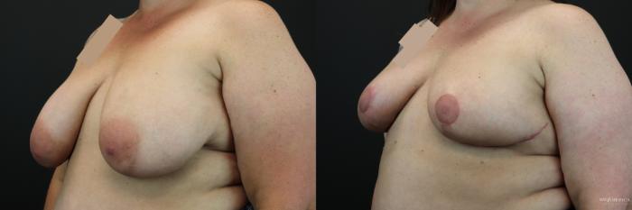 Before & After Breast Reduction Case 246 Left Oblique View in St. Louis, MO