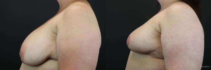 Before & After Breast Reduction Case 246 Left Side View in St. Louis, MO