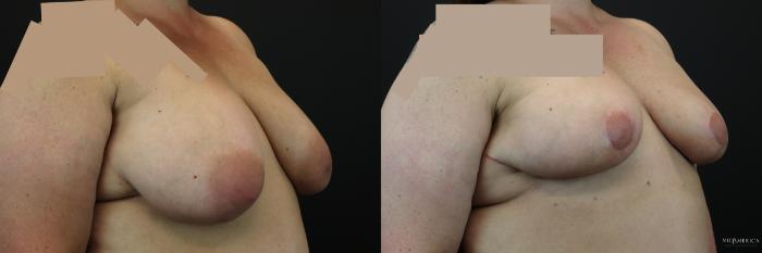 Before & After Breast Reduction Case 246 Right Oblique View in St. Louis, MO