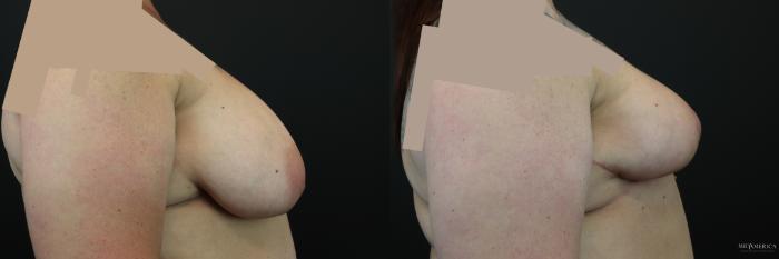 Before & After Breast Reduction Case 246 Right Side View in St. Louis, MO