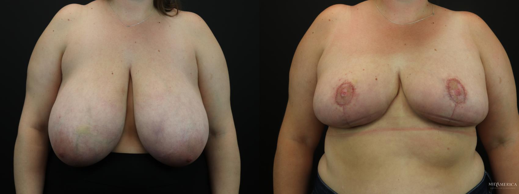 Breast Reduction Case 256 Before & After Front | Glen Carbon, IL | MidAmerica Plastic Surgery