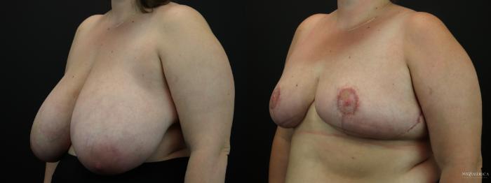 Before & After Breast Reduction Case 256 Left Oblique View in St. Louis, MO