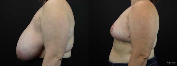 Before & After Breast Reduction Case 256 Left Side View in St. Louis, MO