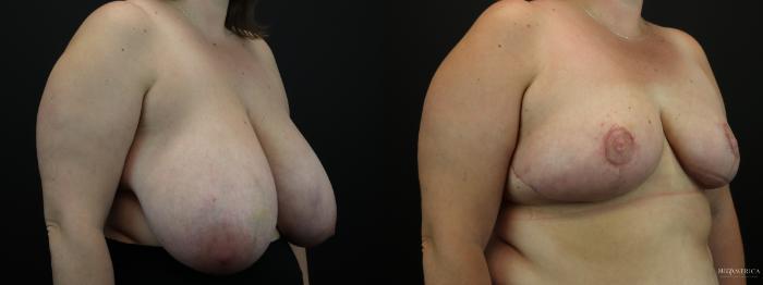 Before & After Breast Reduction Case 256 Right Oblique View in St. Louis, MO