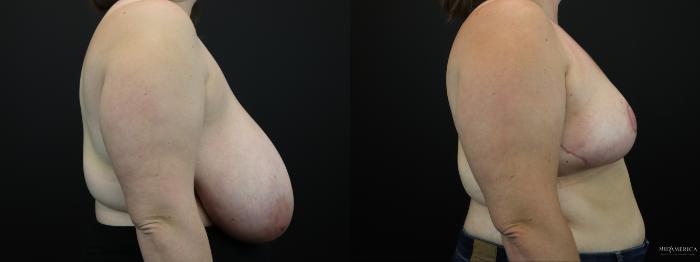 Before & After Breast Reduction Case 256 Right Side View in St. Louis, MO