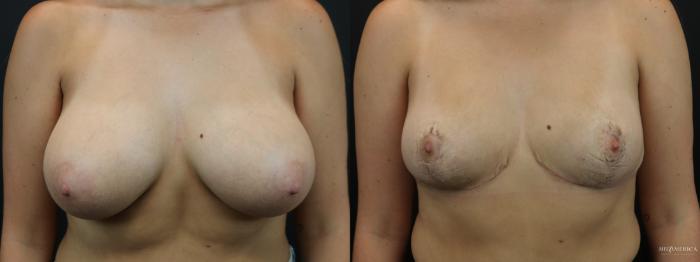 Before & After Breast Reduction Case 261 Front View in St. Louis, MO