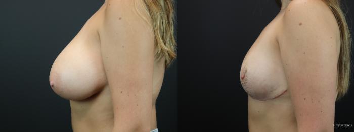 Before & After Breast Reduction Case 261 Left Side View in St. Louis, MO