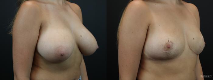 Before & After Breast Reduction Case 261 Right Oblique View in St. Louis, MO