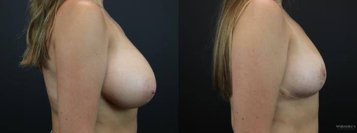 Before & After Breast Reduction Case 261 Right Side View in St. Louis, MO