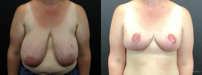 Before & After Breast Reduction Case 276 Front View in Glen Carbon, IL