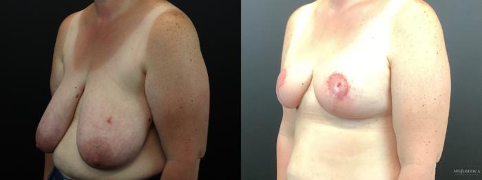 Before & After Breast Reduction Case 276 Left Oblique View in Glen Carbon, IL