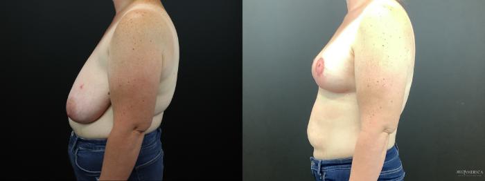 Before & After Breast Reduction Case 276 Left Side View in Glen Carbon, IL