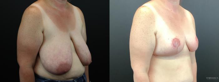 Before & After Breast Reduction Case 276 Right Oblique View in Glen Carbon, IL