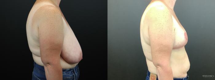Before & After Breast Reduction Case 276 Right Side View in Glen Carbon, IL