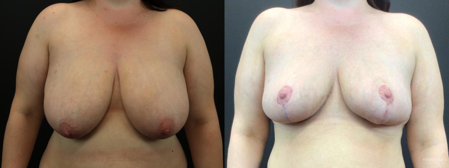 Before & After Breast Reduction Case 277 Front View in Glen Carbon, IL