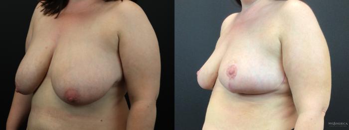 Before & After Breast Reduction Case 277 Left Oblique View in Glen Carbon, IL