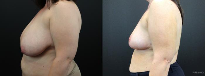 Before & After Breast Reduction Case 277 Left Side View in Glen Carbon, IL